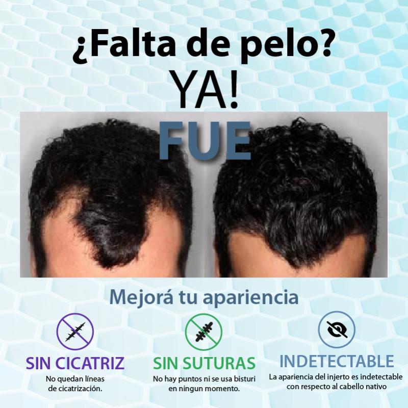 ¿Falta de Pelo?, YA FUE!